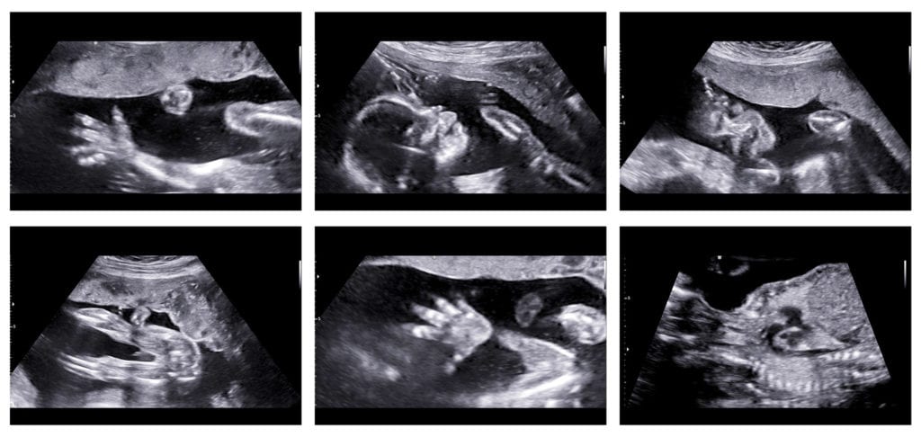 L’Unitat de Diagnòstic Prenatal i Ecografies 3D i 4D d’Embriogyn