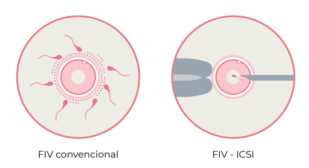fecundació in vitro i FIV ICSI a Embriogyn